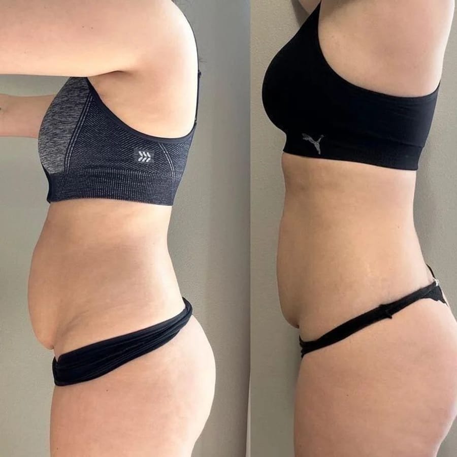 Reductor abdominal · 8 sesiones — antes y después del tratamiento