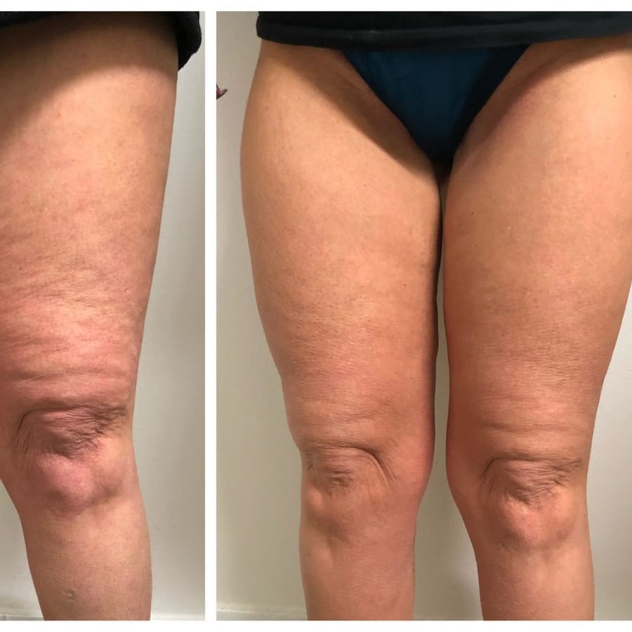Reafirmante de piernas