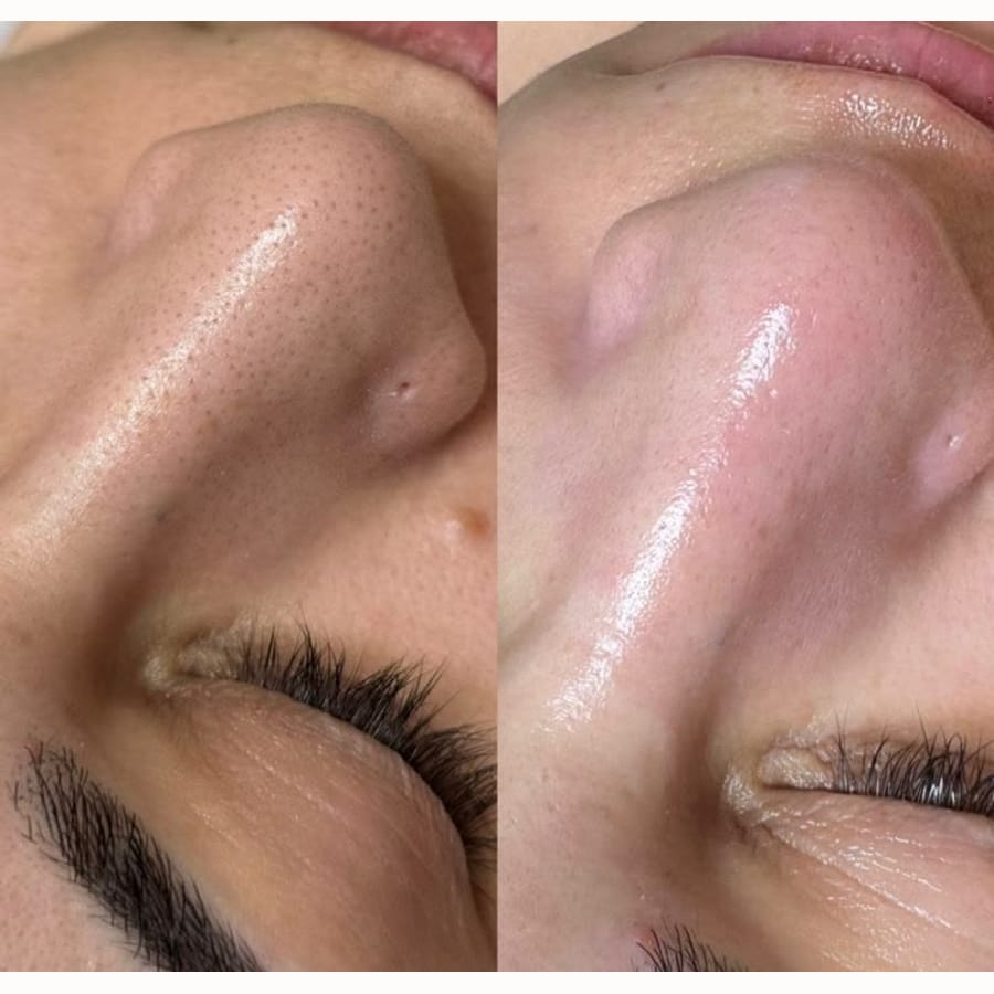 Limpieza profunda + hidratación — antes y después del tratamiento