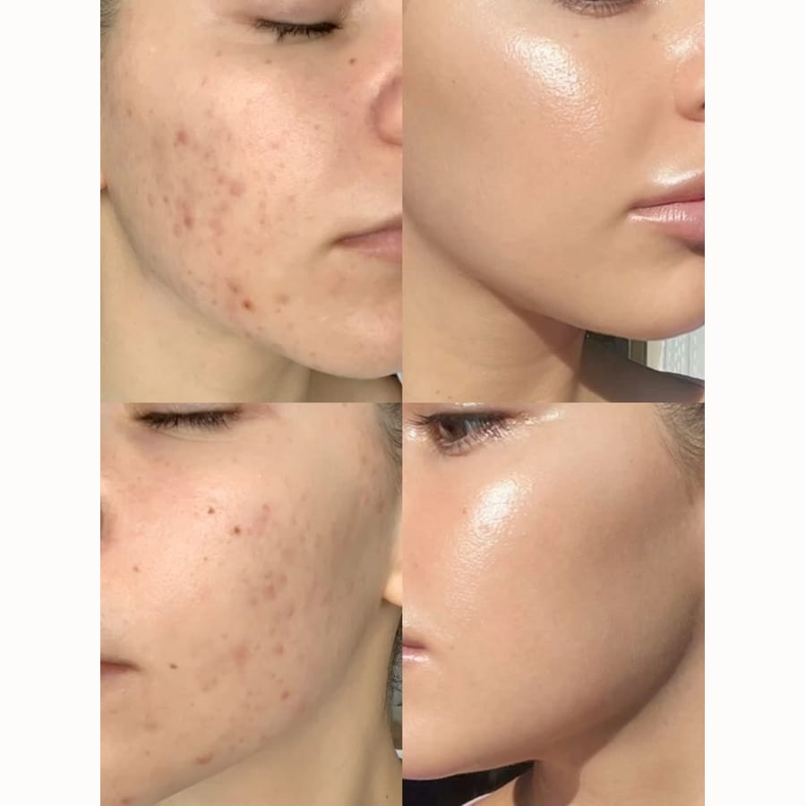 Peeling para marcas de acné — antes y después del tratamiento